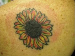 Laser Tattoo Removal Before Laser Tattoo Removal Before