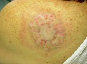 Laser Tattoo Removal After Laser Tattoo Removal After