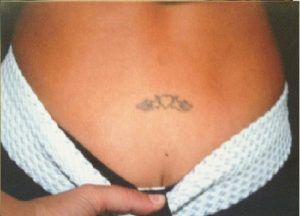 Laser Tattoo Removal Before Laser Tattoo Removal Before