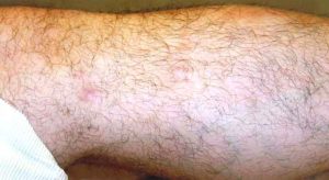 Paramedical Body Treatments - Leg after Paramedical Body Treatments - Leg after