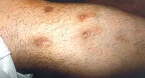 Paramedical Body Treatments - Leg before Paramedical Body Treatments - Leg before