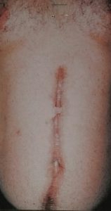 Male Post Traumatic Scarring During Male Post Traumatic Scarring During
