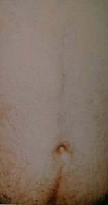 Male Post Traumatic Scarring After Male Post Traumatic Scarring After