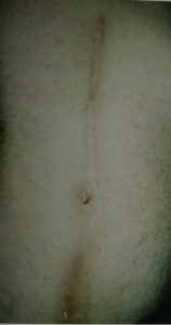 Male Post Traumatic Scarring Before Male Post Traumatic Scarring Before