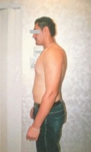 Weight Loss After Weight Loss After