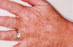 Paramedical Body Treatments - Hand Pigmentation Paramedical Body Treatments - Hand Pigmentation