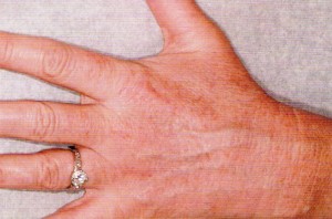 Paramedical Hand Pigmentation Treatment Paramedical Hand Pigmentation Treatment
