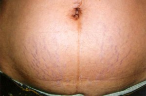 Stretchmarks Stretchmarks
