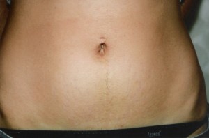 Stretchmarks Stretchmarks