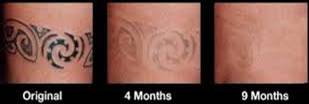 tattoo-fading