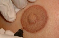 Medical 3D Areola Micro Pigmentation