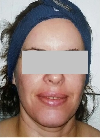 Female Pigmentation Facial Treatments