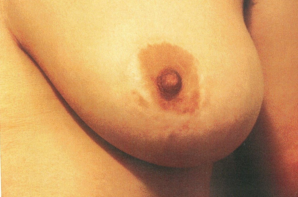 Areola and Scar Camouflage Before