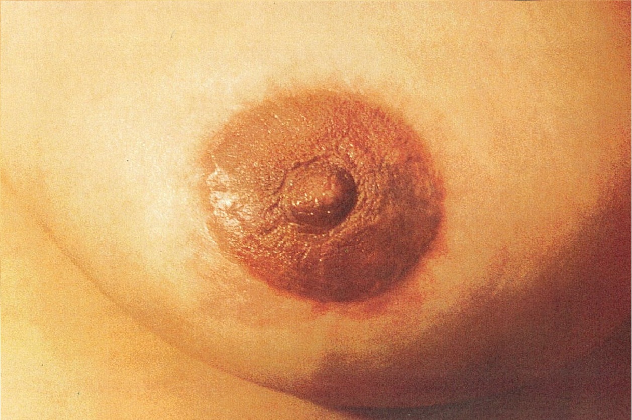 Areola and Scar Camoflage Before Areola and Scar Camoflage Before
