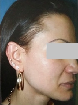 Female Open Pores After Left Side