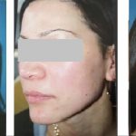 Female Open Pores and Defused Redness