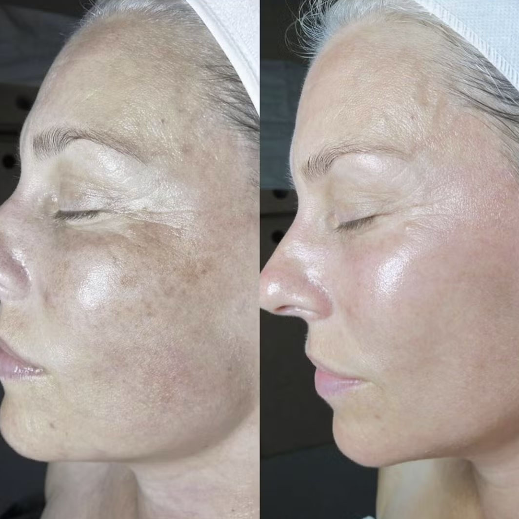 skin booster 3