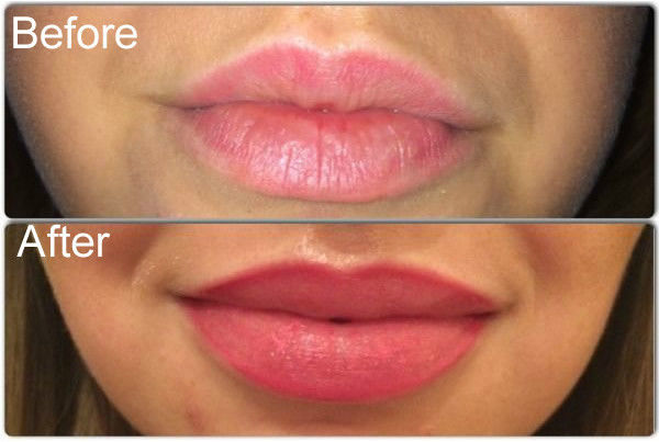 Full Lip Restoration