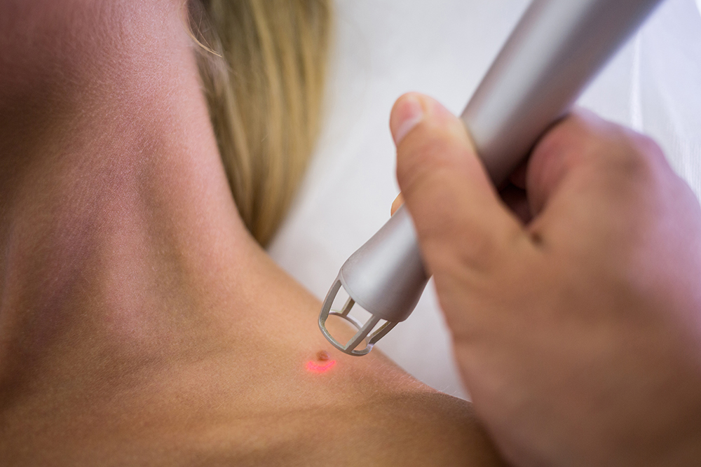 Tattoo Removal — Progress