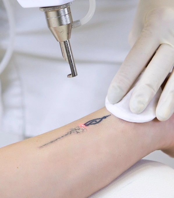 tattoo removal training course