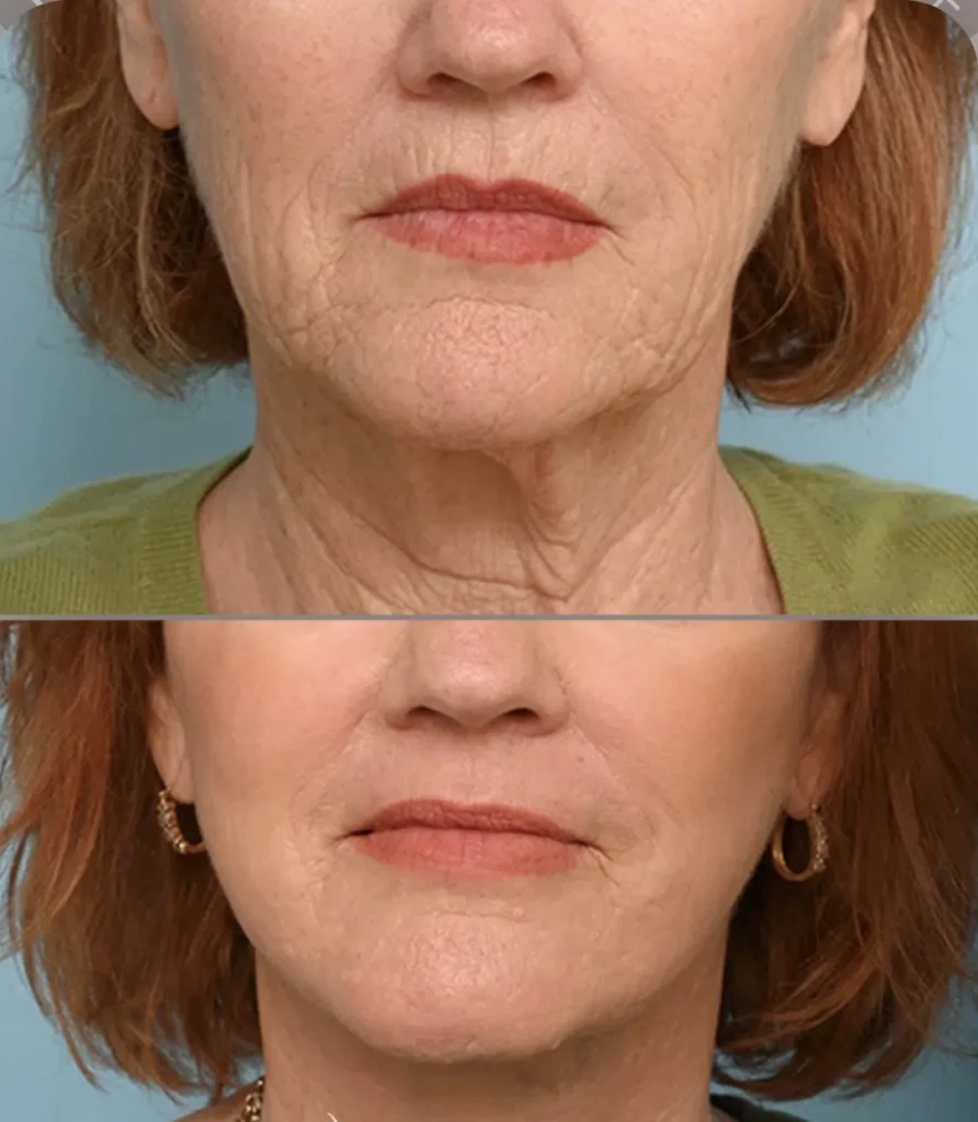 Fractional CO2 laser resurfacing before and after – lower face wrinkles and jawline