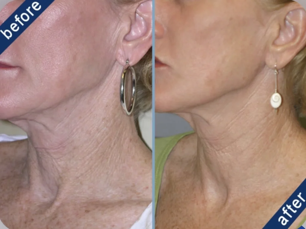 Fractional CO2 laser before and after – crepey neck skin tightening