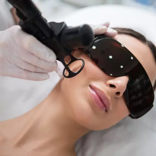 Client wearing laser safety goggles during a fractional CO2 laser resurfacing treatment